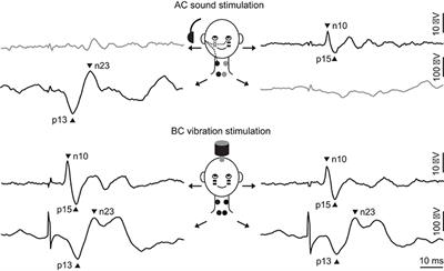 The Contributions of Vestibular Evoked Myogenic Potentials and Acoustic Vestibular Stimulation to Our Understanding of the Vestibular System